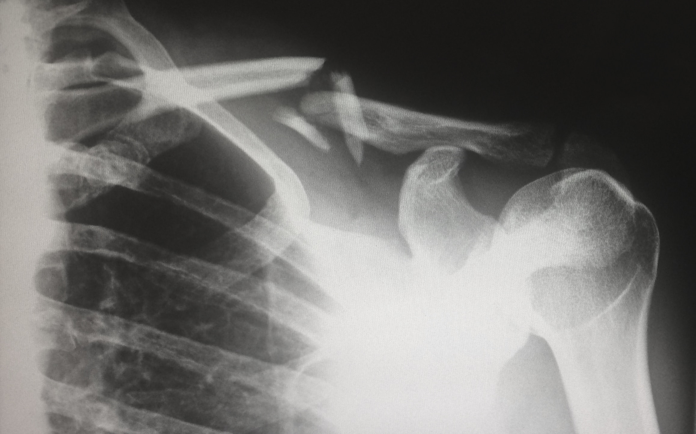 Personal Injury: Broken Collarbone X-ray