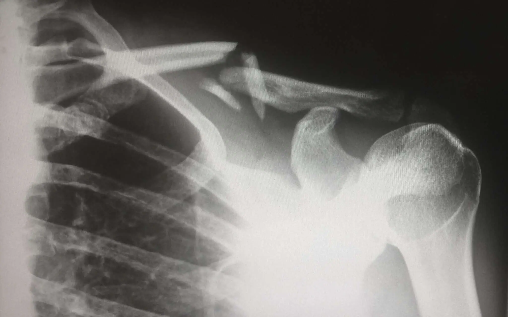 Personal Injury Caused During Sporting or Outdoor Activities
