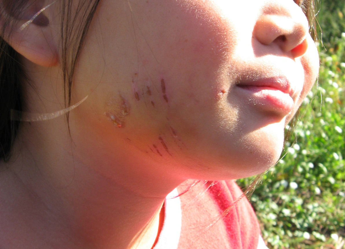 Dog Attacks—Does Breed Matter?